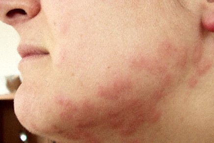 Bed Bug Bite | How Do You Know If You Have Bed Bugs
